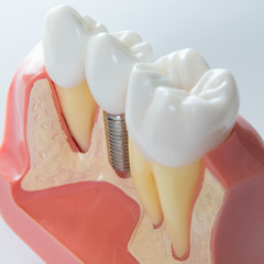 a dental implant between two natural teeth